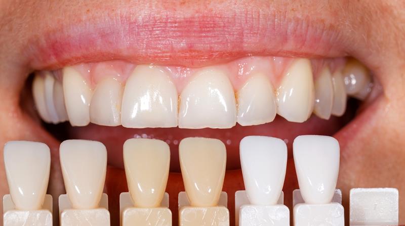 Veneers SE nd St Suite
